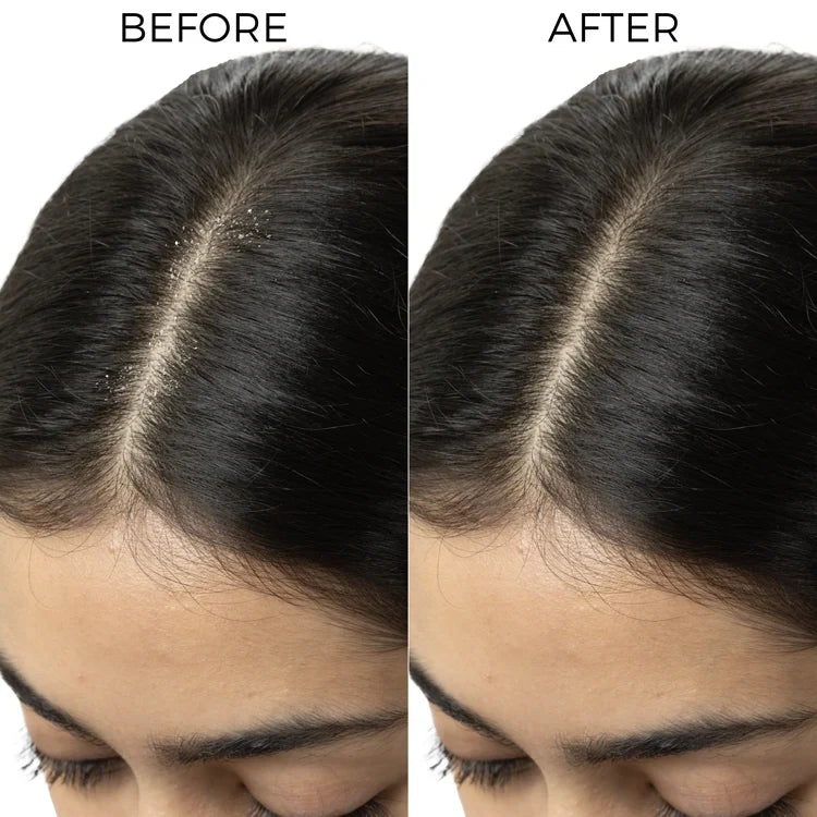 Brillare - Mini Dandruff Control Mask For Itchy, Flaky Scalp 20ml - Nexus hair